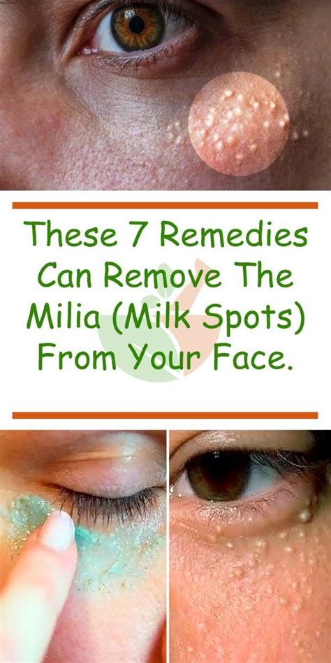 These 7 Remedies Can Remove The Milia Milk Spots From Your Face