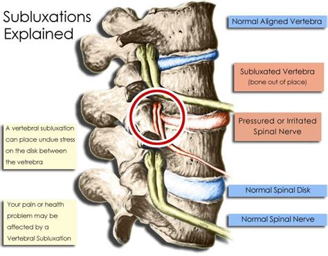 Subluxations Diagram Complete Chiropractic Complete Chiropractic