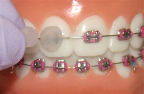 Orthodontic Wax Can Be The Answer To Discomfort And Irritation Texas