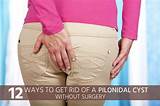 Can You Drain A Pilonidal Cyst At Home Photos