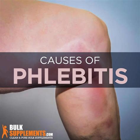 Phlebitis Symptoms Causes And Treatment Bulksupplements Health