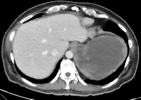 Abdominal Cyst Of Unclear Aetiology Gastrointestinal Stromal Tumour Or