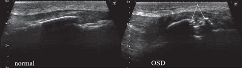 Figure 1 From Osgood Schlatter Disease In Ultrasound Diagnostics A