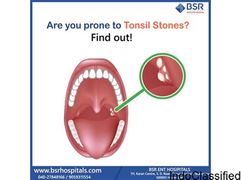 Tonsillitis Causes Symptoms And Treatment Book An Appointment