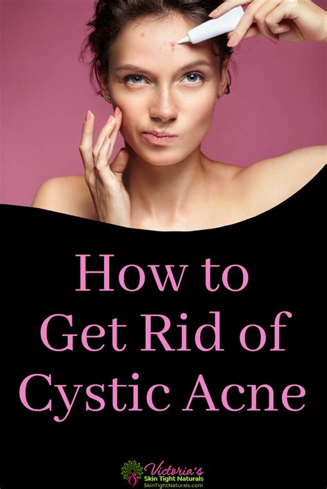 Cystic Acne How To Get Rid Of It Skin Tight Naturals