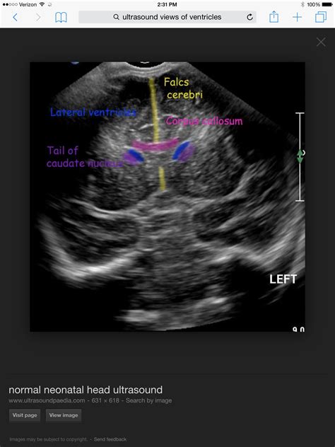 Fetal Head Ultrasound Medical Ultrasound Diagnostic Medical Sonography