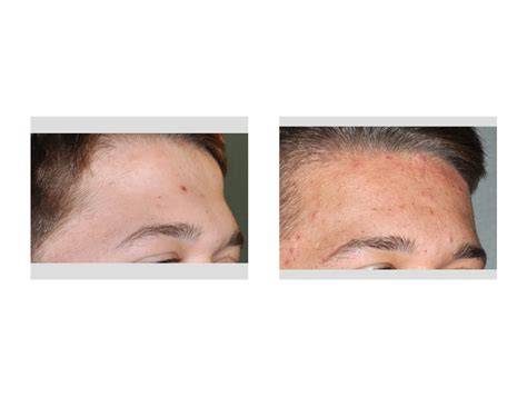 Case Study Forehead Augmentation For Forehead Horns Explore Plastic