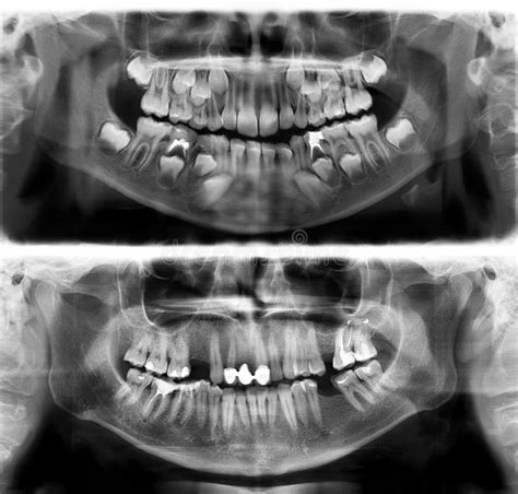 Panoramic Radiograph Is A Panoramic Scanning Dental X Ray Of The