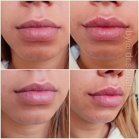 His Client Had Enhanced The Shape Sharpened The Cupids Bow