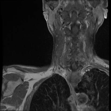 Pancoast Tumor Treated With Radiotherapy Image