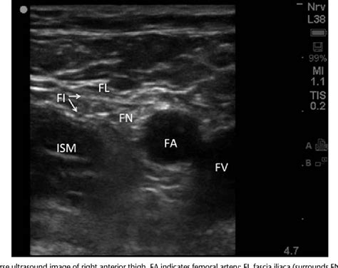 Ultrasound Guided Femoral Nerve Block Nysora Nysora