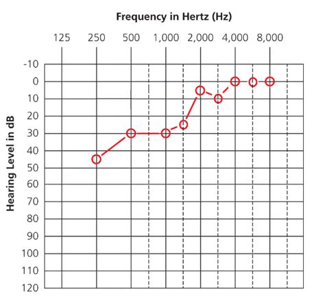 Low Frequency Hearing Loss Ziphearing