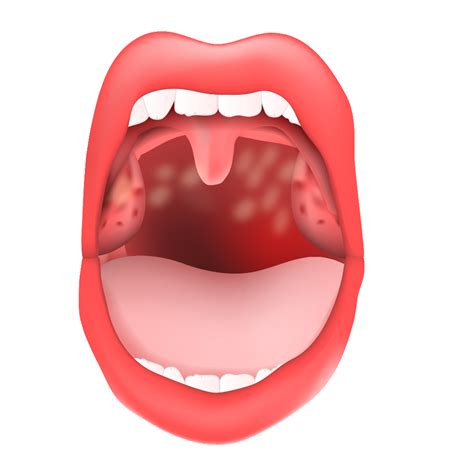 引起口腔白斑的原因 为什么会出现口腔白斑 京东健康