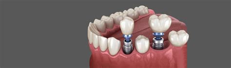Do Dental Implants Cause Cancer Dental News Network