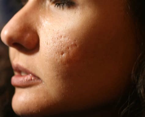 How To Get Rid Of Acne Scars Healthstatus