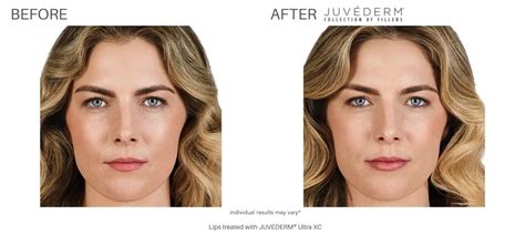 Juvéderm Before And After Real Results From Real Patients