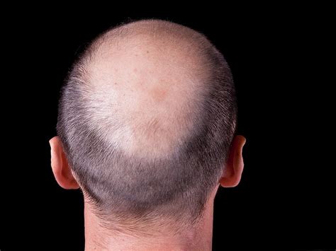 Drug Lessens Psoriatic Plaques While Reversing Baldness