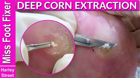 satisfying deep corn extraction and removal by miss foot fixer youtube
