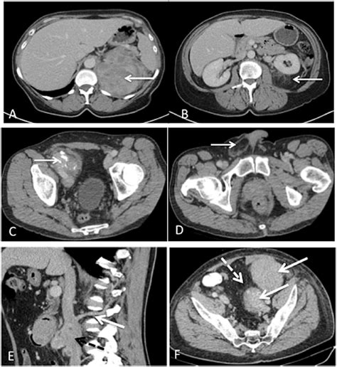 Surgical Planning Contrast Enhanced Ct In The Same Patient A And B