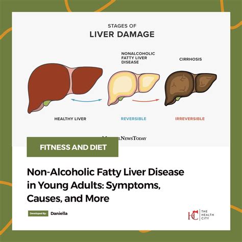 The Health City Non Alcoholic Fatty Liver Disease In Young Adults