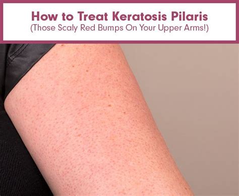 How To Treat Keratosis Pilaris Those Scaly Red Bumps On Your Upper