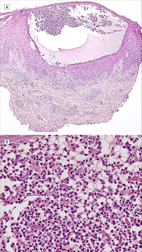 Indomethacin For Refractory Infantile Eosinophilic Pustular