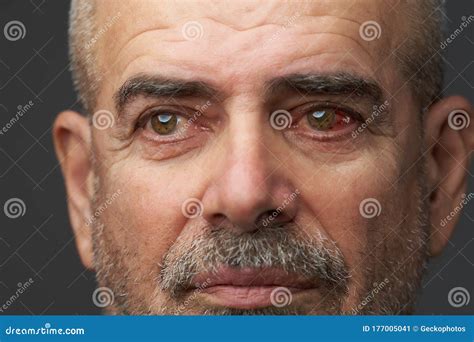 Close Up Annoyed Red Blood Eye Of Senior Man Stock Image Image Of