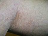 Eczema On Back Of Knees Treatment Photos