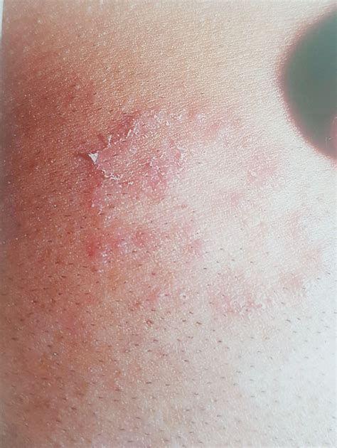 Resistant Cases Of Tinea Cruris Oman Observer