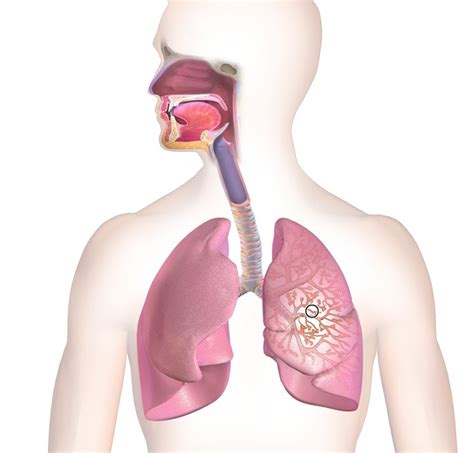 Las diferencias entre neumonía y bronquitis