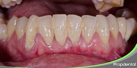 la movilidad dentaria  la periodontitis