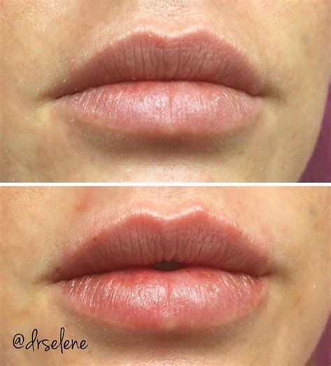 Pout Perfection This Beauty Received A 12 Syringe Of Juvederm Ultra