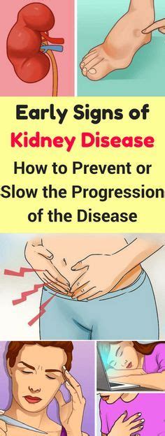 It may only be diagnosed if you have a blood or urine test for another reason and the results show a. Early Signs Of Kidney, Disease-Also, How To Prevent Or ...