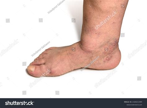 Swelling Female Leg Inflammation Diabetic Nephropathy Stock Photo