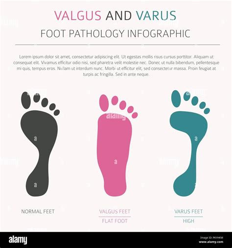 Foot Deformation As Medical Desease Infographic Valgus And Varus