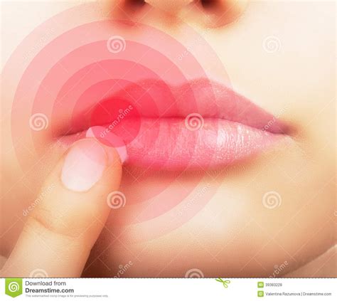 Labbra colpite da herpes. fotografia stock. Immagine di erpete - 39383228