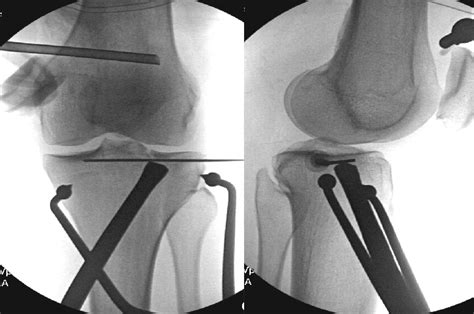 Arthroscopic Assisted Reduction And Percutaneous Fixation Of Tibial