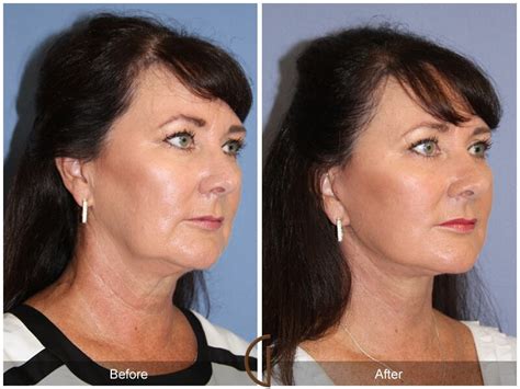 Facelift Fifties Before And After Photos Patient 64 Dr Kevin Sadati