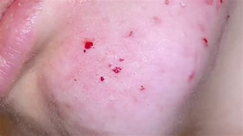 Your New Fave Extractions 5 Blackheads Whiteheads Ear Extractions