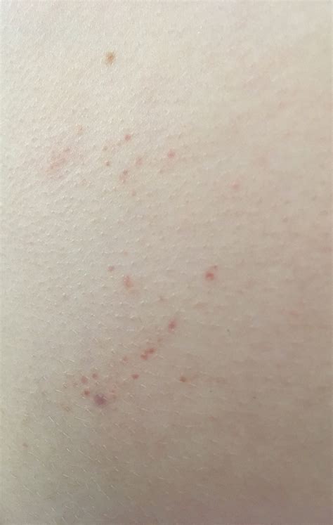 Pinprick Red Dots Under Skin Askdocs