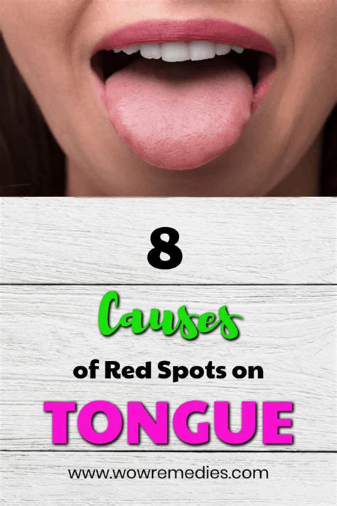 Red Spots On Tongue Causes Symptoms Home Remedies Kulturaupice