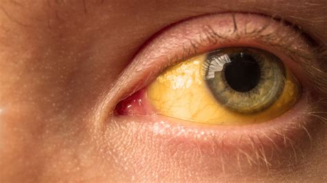 Yellow eyes can have various causes, ranging in severity from 'troubling' to 'generally fatal'. What It Really Means When Your Eyes Turn Yellow