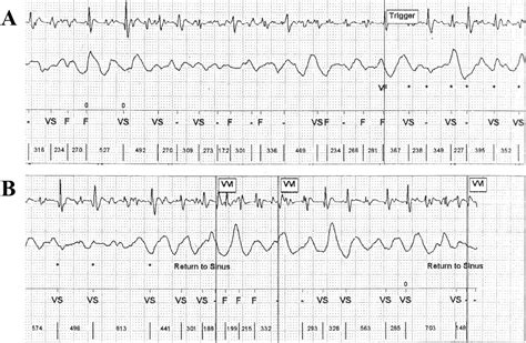 What Is The Icd 10 Code For Sinus Tachycardia