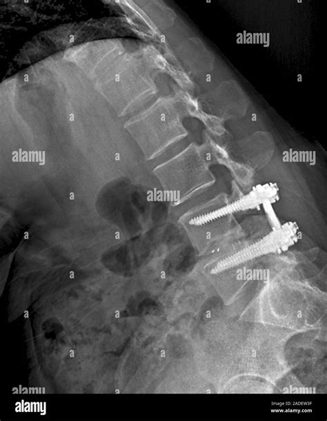 Traitement de l hernie discale de la colonne vertébrale X ray d une