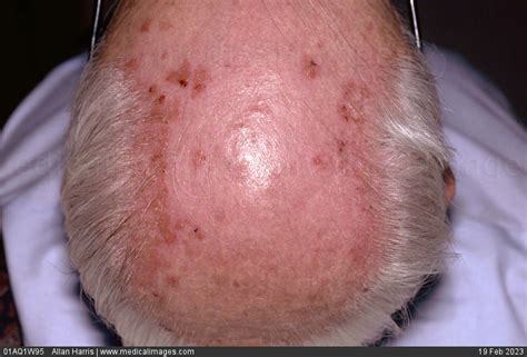 Stock Image Dermatology Moderate Psoriasis On Scalp Pink Patches