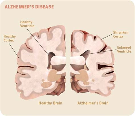 Dementia 101 Know The Different Types Of Dementia