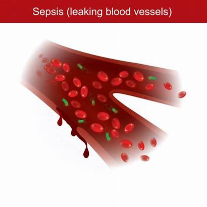 Sepsis Blood Vector Bacterial Leaking Vessels Infections