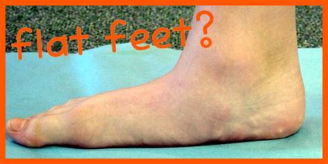 A flexible flat foot is a foot that has the ability to form an arch but the arch flattens when weight is put on the leg. Can I still run with flat feet? - Dr. Nick's Running Blog