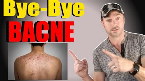 Clear Back Acne Bacne Treatment Video Chris Gibson Youtube