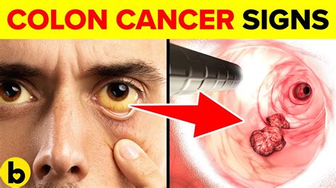 11 Early Signs Of Colon Cancer You Need To Know Youtube
